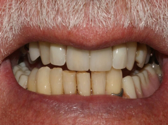Dental Treatment - After