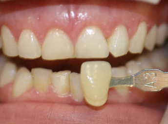 Teeth Whitening - Before