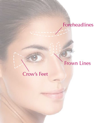 Anti-Wrinkle Injection Sites