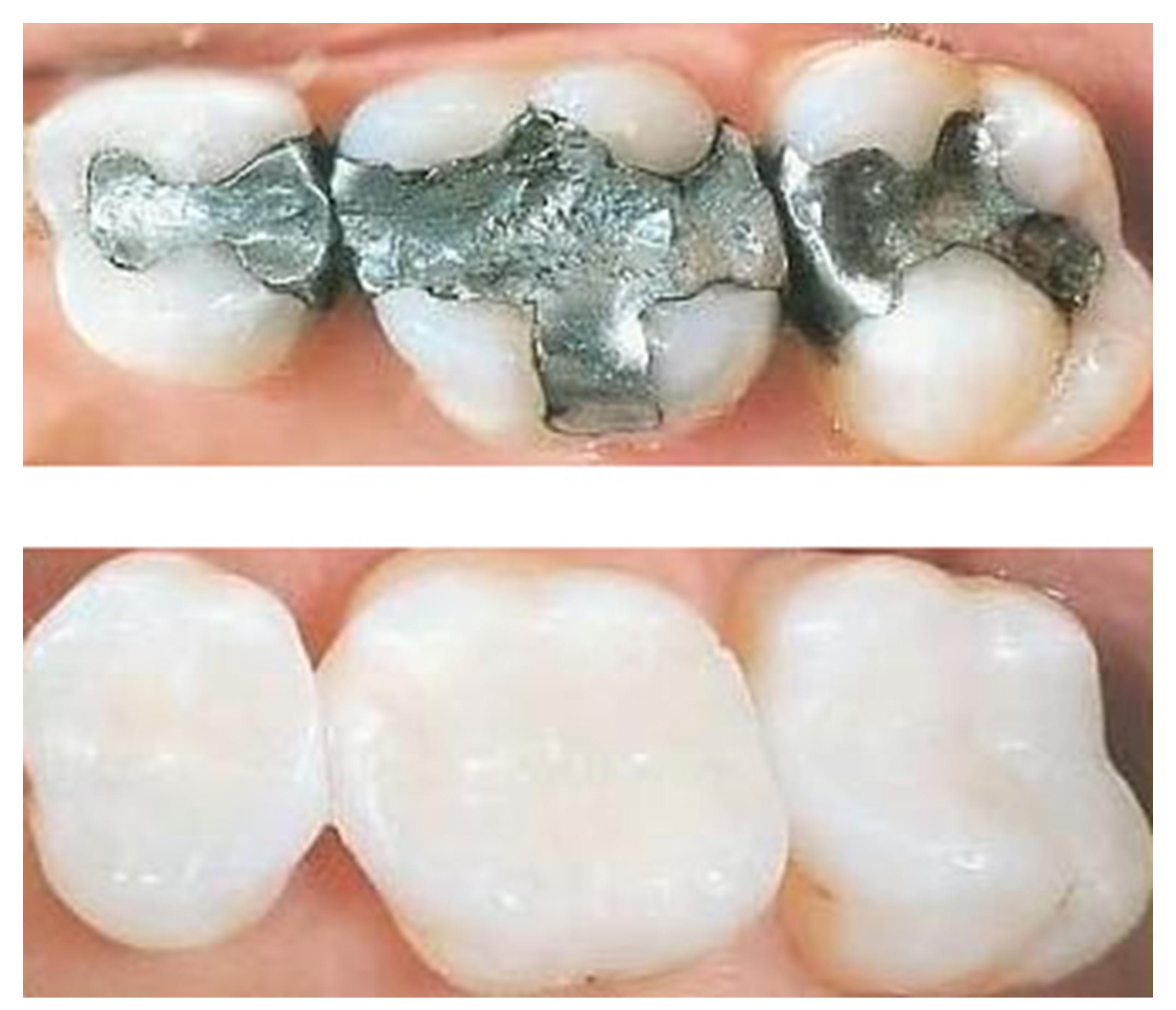 Natural Coloured Fillings