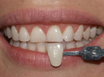 Dental Treatment - After